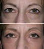 eyelid-surgery-4-032 3