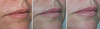 lip-implant-1-036 16