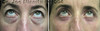 eyelid-surgery-2-048 12