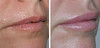 lip-implant-1-008 7