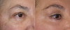 eyelid-surgery-6-028 18