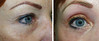 eyelid-surgery-1-044 4
