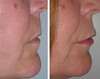 lip-implant-1-045 7