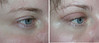 eyelid-surgery-2-100 1