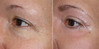 eyelid-surgery-3-015 13