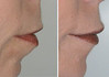 lip-implant-1-020 1