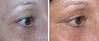 eyelid-surgery-2-036 0