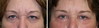 eyelid-surgery-5-036 16