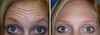 botox-forehead-wrinkles-1-001 0