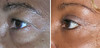 eyelid-surgery-1-052 12