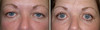 eyelid-surgery-1-031 11