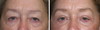 eyelid-surgery-6-044 15