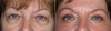 eyelid-surgery-3-006 4