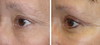 eyelid-surgery-4-061 13