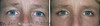 eyelid-surgery-2-071 10