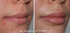 lip-implant-1-041 3