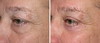 eyelid-surgery-6-036 7