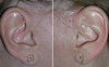 facelift-incisions-1-024 5