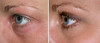 eyelid-surgery-2-005 1