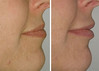 lip-implant-1-021 2