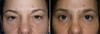 eyelid-surgery-7-029 11