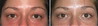 eyelid-surgery-7-015 1