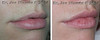 lip-implant-1-025 5