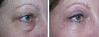eyelid-surgery-2-003 18