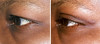 eyelid-surgery-2-028 5