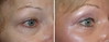 eyelid-surgery-6-045 16