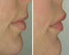 lip-implant-1-035 15
