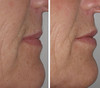 lip-implant-1-051 13