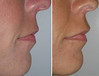 lip-implant-1-011 10