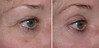 eyelid-surgery-3-025 15
