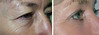 eyelid-surgery-2-021 17