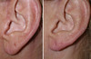 earlobe-reduction-1-015 14