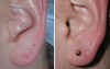 earlobe-repair-1-016 15