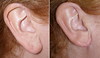 earlobe-reduction-1-001 0