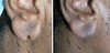earlobe-repair-1-022 3