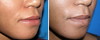 lip-implant-1-003 2