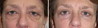 eyelid-surgery-5-002 1
