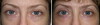 eyelid-surgery-5-010 7