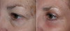 eyelid-surgery-4-003 12