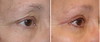 eyelid-surgery-4-063 12
