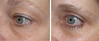 eyelid-surgery-4-035 6