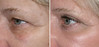 eyelid-surgery-1-030 10
