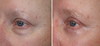 eyelid-surgery-5-021 1
