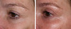 eyelid-surgery-1-007 6
