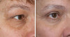 eyelid-surgery-3-012 2