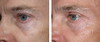 eyelid-surgery-4-054 6